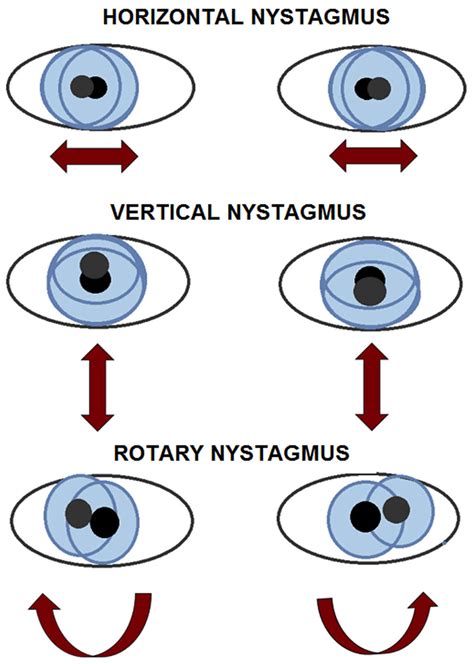 Overcome Nystagmus with Expert Optometrist Care